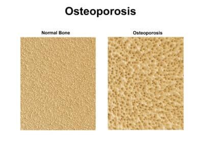Image d'une densité osseuse saine et une autre avec ostéoporose