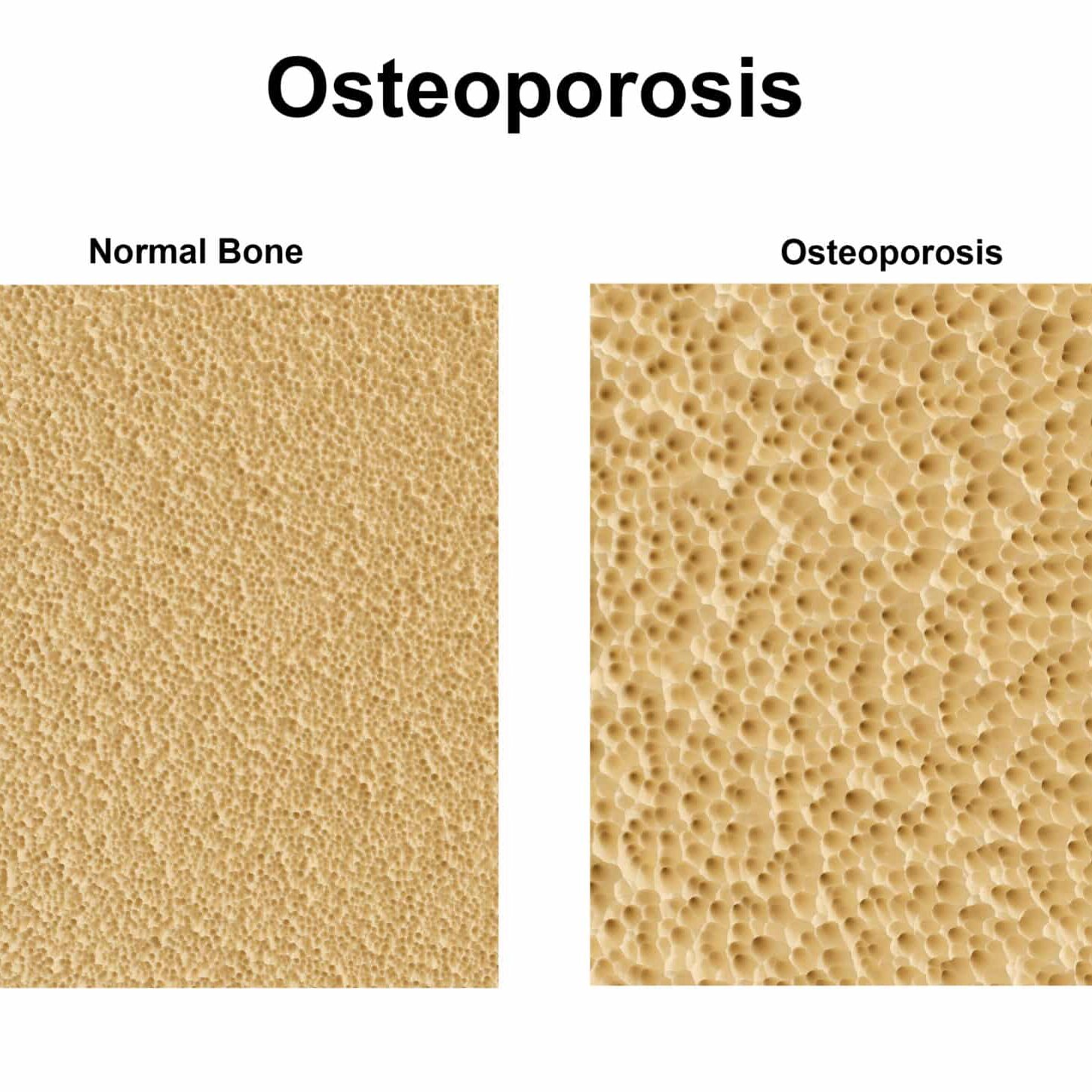 Image d'une densité osseuse saine et une autre avec ostéoporose